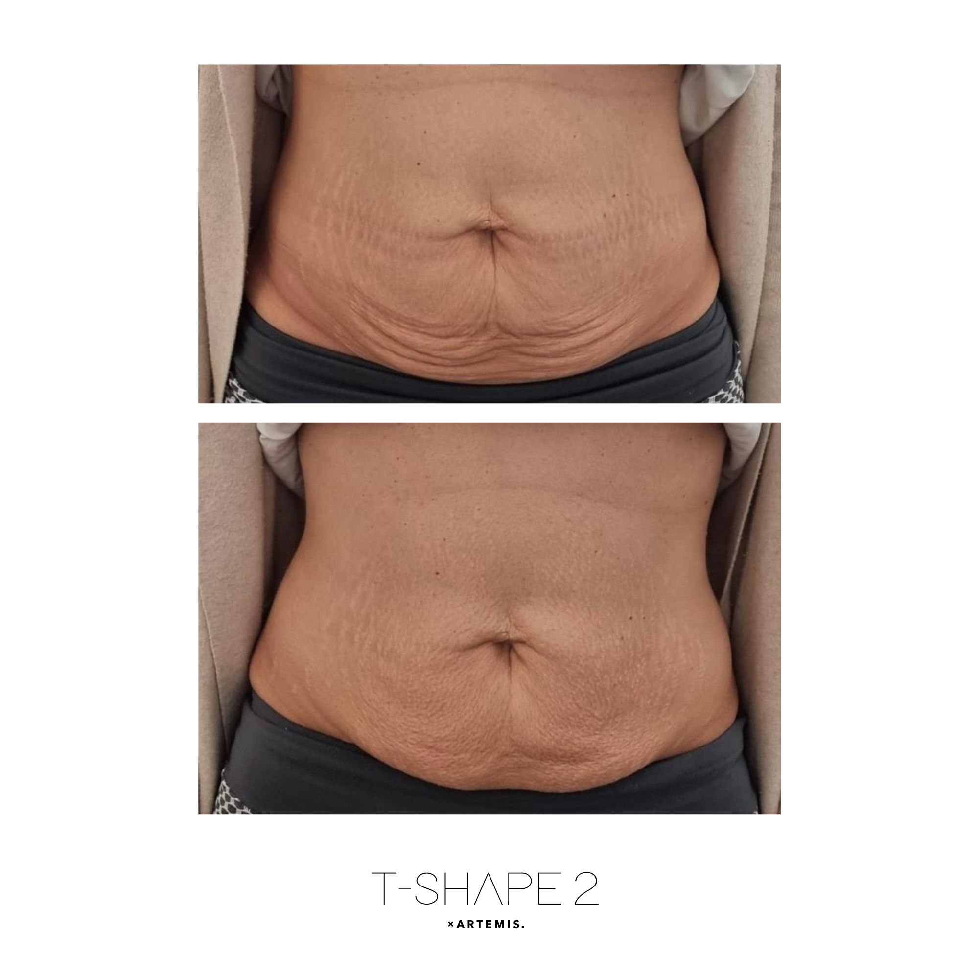 Abs — After treatment series