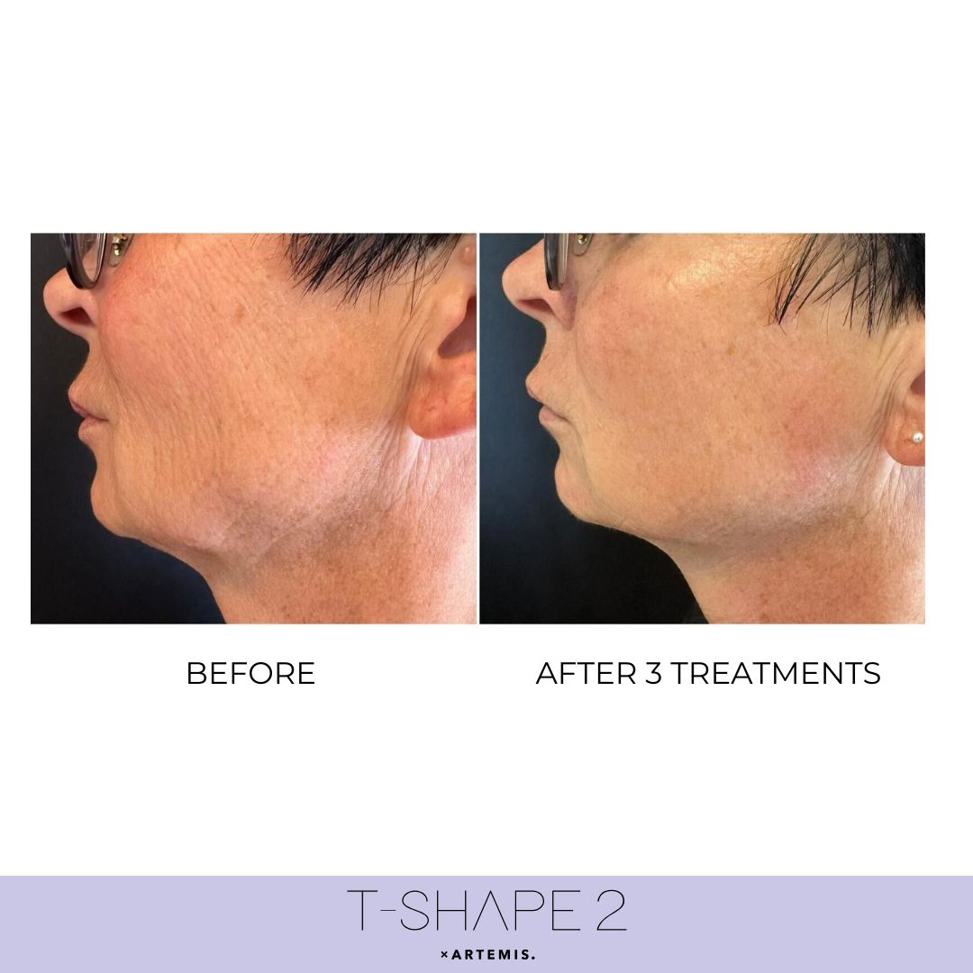 Neck — After 3 treatments
